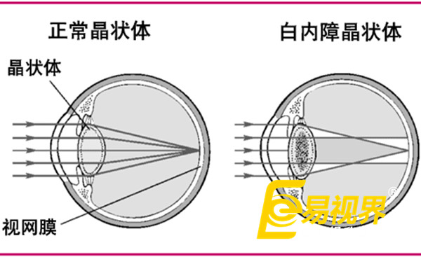  春节过量饮酒最伤眼 易视界