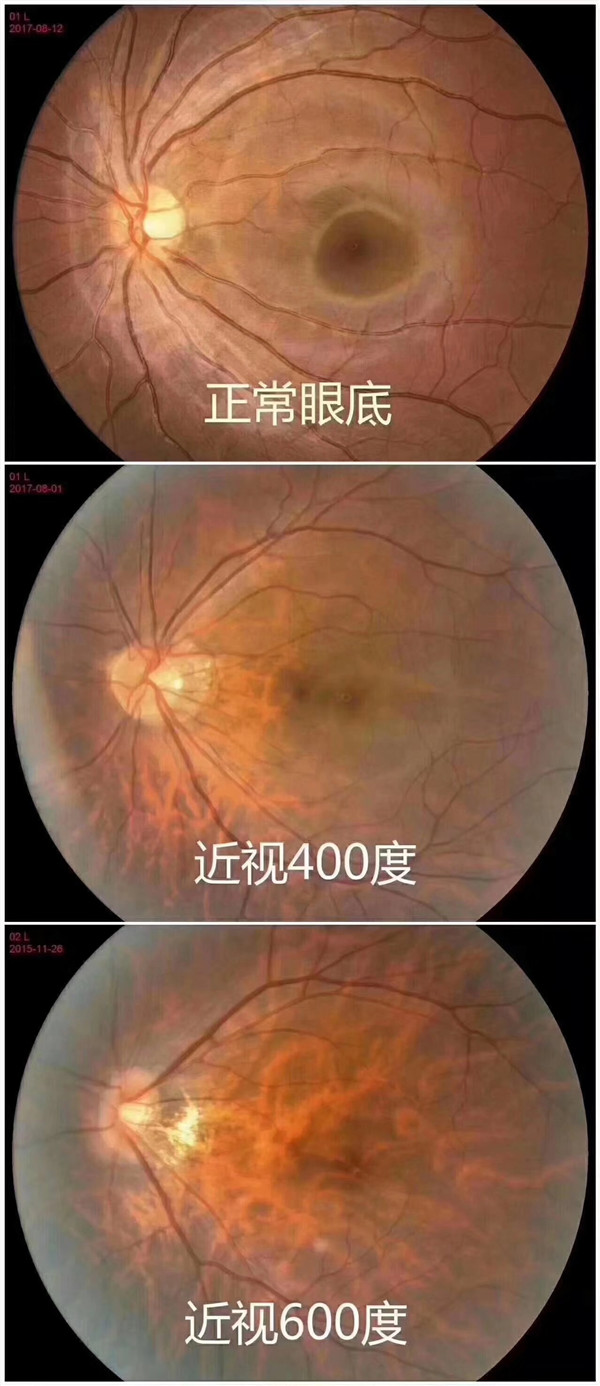 保护孩子视力 易视界人在行动