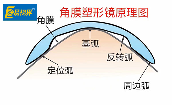 近视以后可否戴角膜塑形镜【易视界眼健康管理机构】