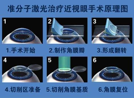 激光手术适合所有人吗？