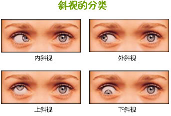 孩子斜视是怎么回事