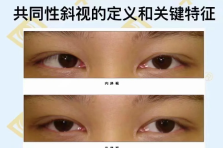 共同性斜视的定义和关键特征