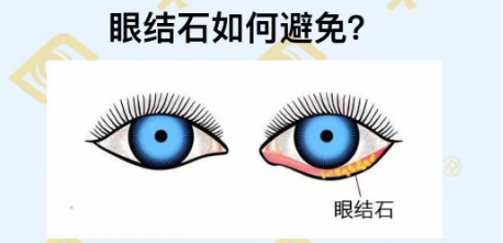 眼结石如何避免