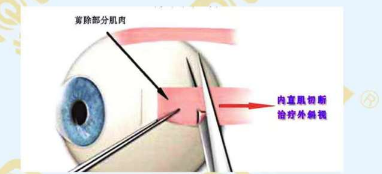 斜视手术需前需要满足的条件