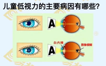 儿童低视力主要病因有哪些?