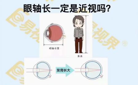 眼轴长一定是近视吗?
