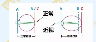哪个年龄近视度数最容易增长?