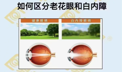如何区分老花眼和白内障?