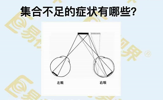集合不足的症状有哪些?
