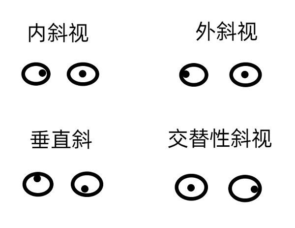 斜视早期的症状有哪些?